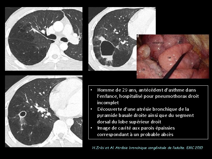  • Homme de 29 ans, antécédent d’asthme dans l’enfance, hospitalisé pour pneumothorax droit