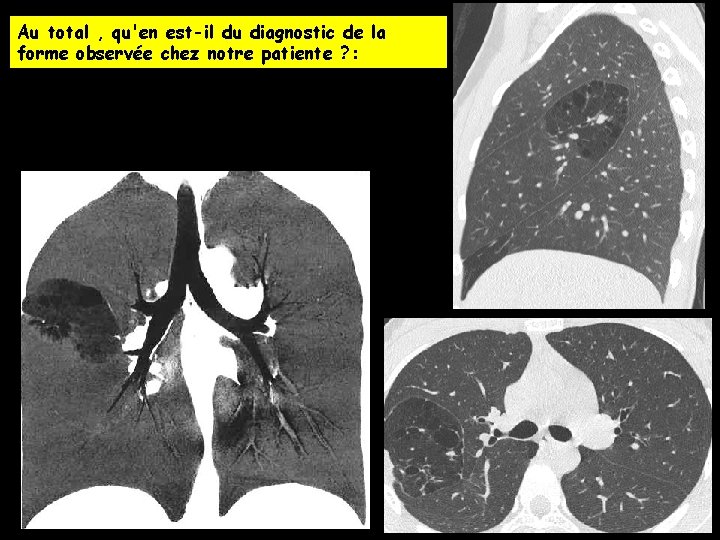 Au total , qu'en est-il du diagnostic de la forme observée chez notre patiente