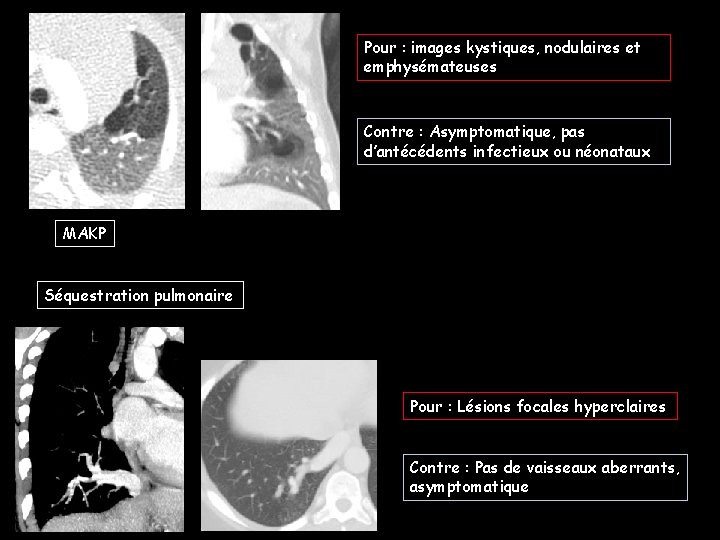 Pour : images kystiques, nodulaires et emphysémateuses Contre : Asymptomatique, pas d’antécédents infectieux ou