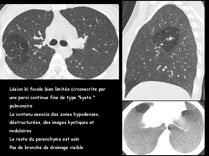 Lésion bi focale bien limitée circonscrite par une paroi continue fine de type "kyste