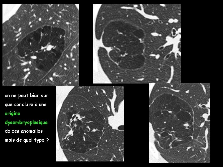 on ne peut bien sur que conclure à une origine dysembryoplasique de ces anomalies,