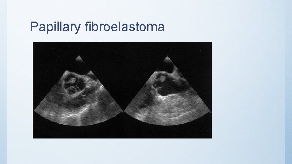 Papillary fibroelastoma 