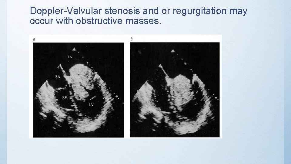 Doppler-Valvular stenosis and or regurgitation may occur with obstructive masses. 