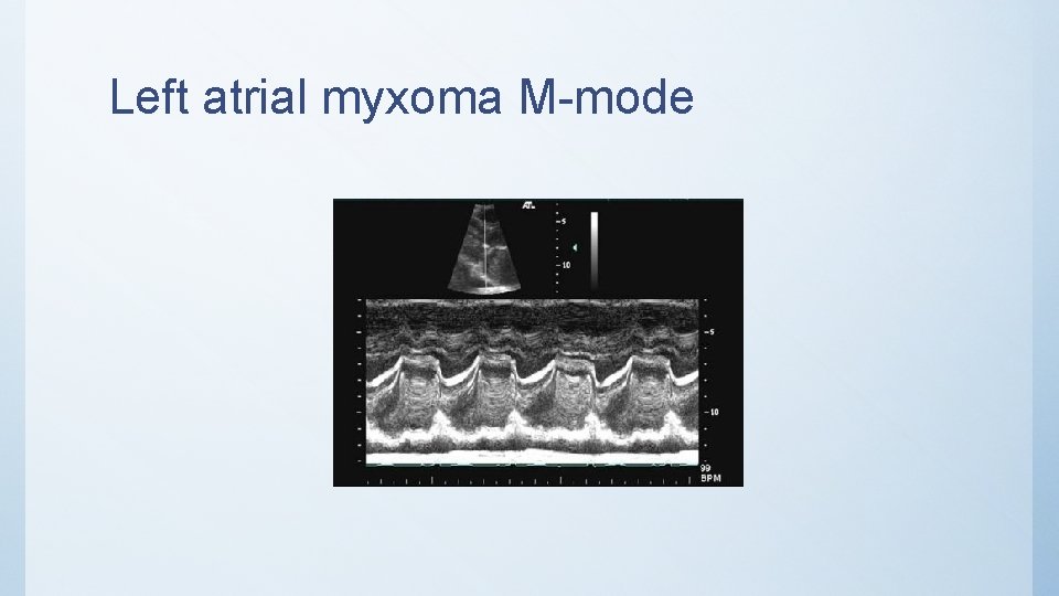 Left atrial myxoma M-mode 