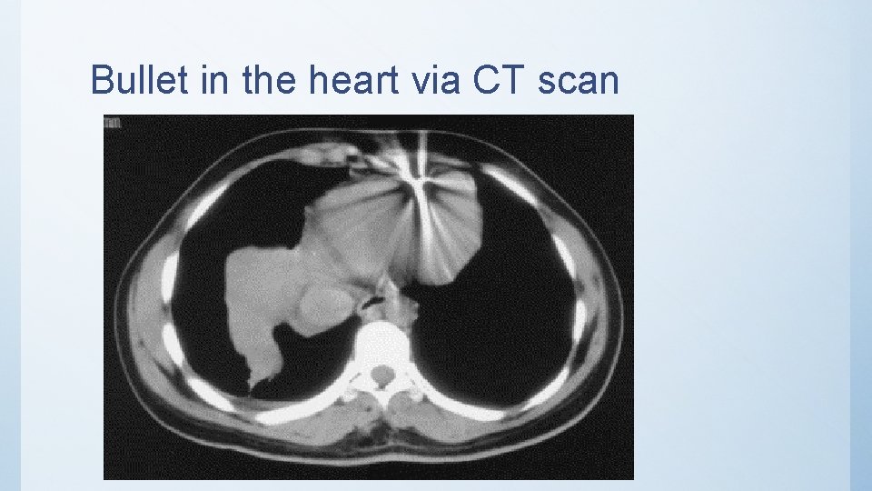 Bullet in the heart via CT scan 