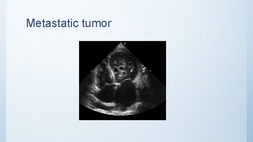 Metastatic tumor 