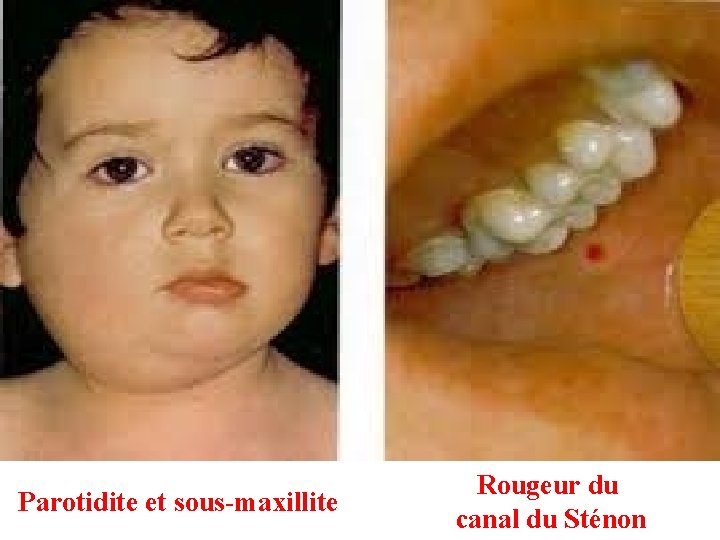 Parotidite et sous-maxillite Rougeur du canal du Sténon 