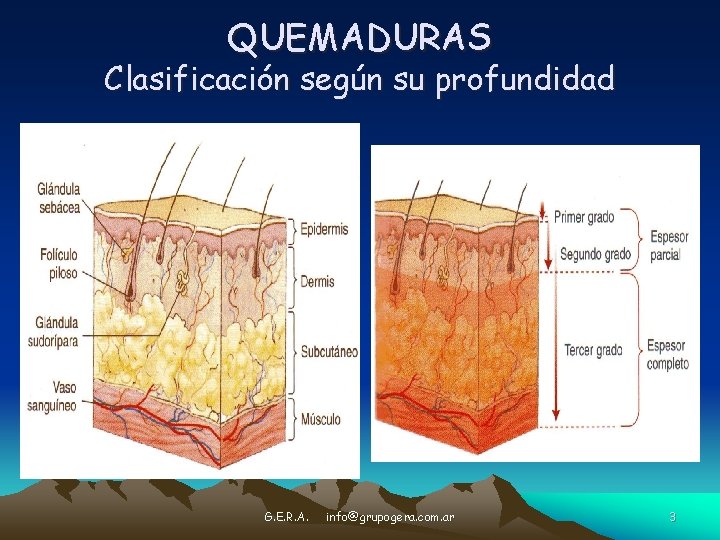 QUEMADURAS Clasificación según su profundidad G. E. R. A. info@grupogera. com. ar 3 