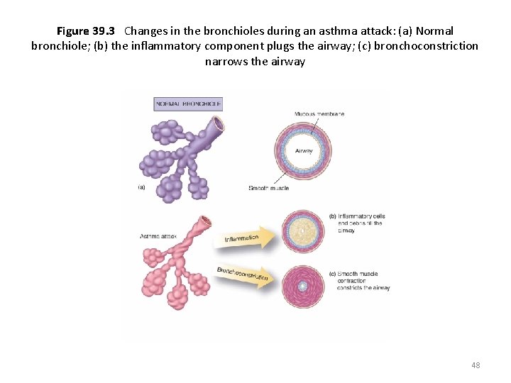 Figure 39. 3 Changes in the bronchioles during an asthma attack: (a) Normal bronchiole;