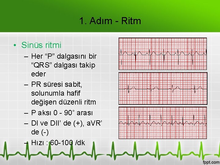 1. Adım - Ritm • Sinüs ritmi – Her “P” dalgasını bir “QRS” dalgası