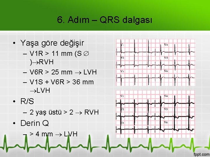 6. Adım – QRS dalgası • Yaşa göre değişir – V 1 R >