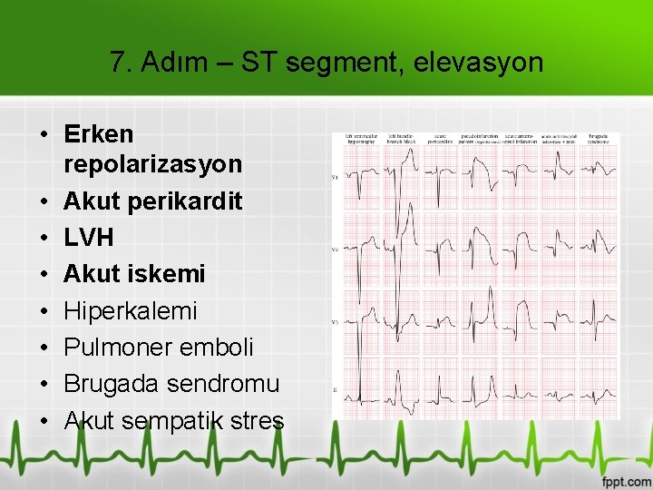 7. Adım – ST segment, elevasyon • Erken repolarizasyon • Akut perikardit • LVH