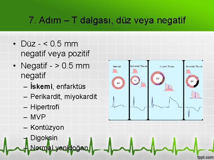 7. Adım – T dalgası, düz veya negatif • Düz - < 0. 5