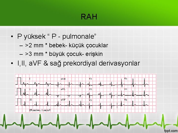 RAH • P yüksek “ P - pulmonale” – >2 mm * bebek- küçük