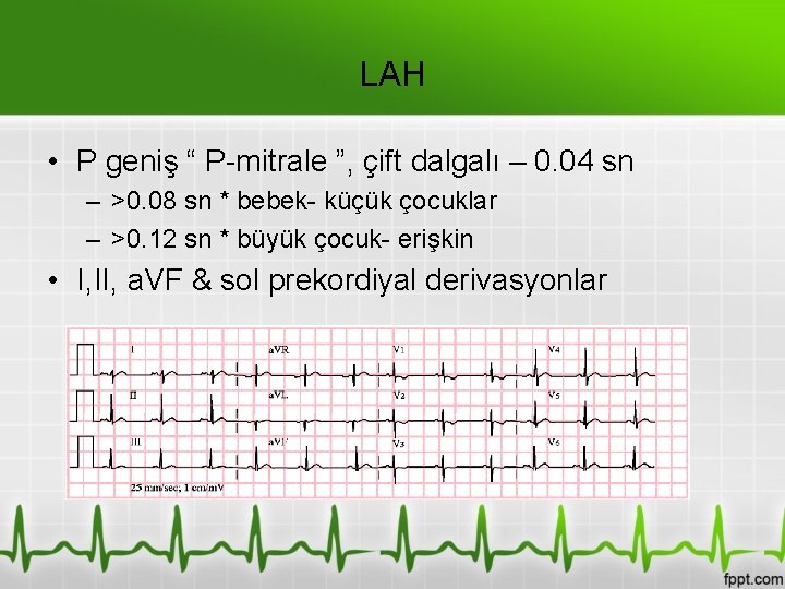 LAH • P geniş “ P-mitrale ”, çift dalgalı – 0. 04 sn –