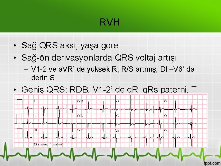 RVH • Sağ QRS aksı, yaşa göre • Sağ-ön derivasyonlarda QRS voltaj artışı –