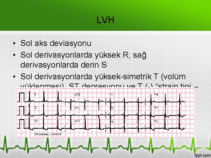LVH • Sol aks deviasyonu • Sol derivasyonlarda yüksek R, sağ derivasyonlarda derin S