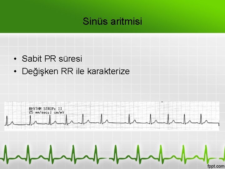 Sinüs aritmisi • Sabit PR süresi • Değişken RR ile karakterize 