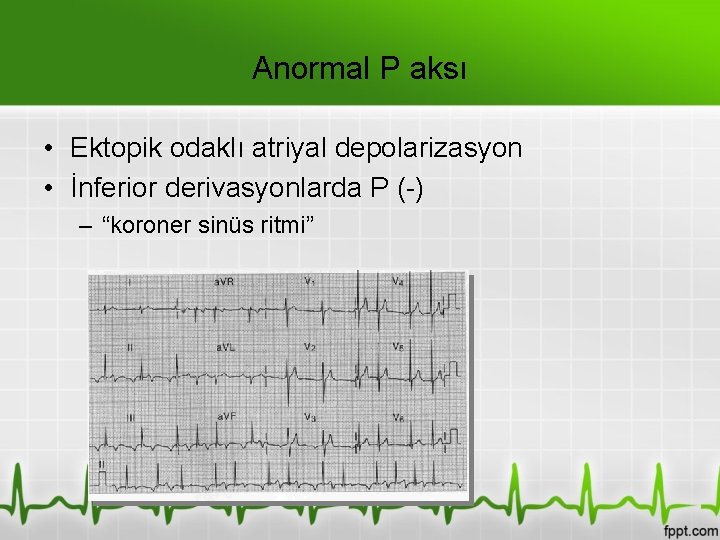 Anormal P aksı • Ektopik odaklı atriyal depolarizasyon • İnferior derivasyonlarda P (-) –