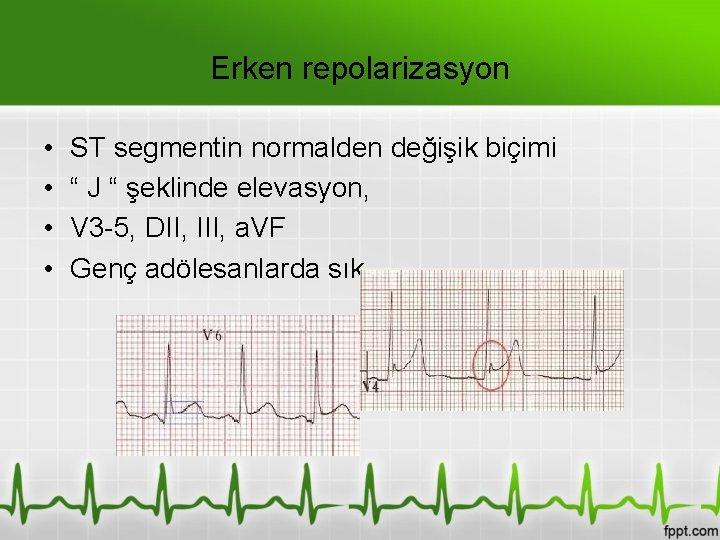 Erken repolarizasyon • • ST segmentin normalden değişik biçimi “ J “ şeklinde elevasyon,