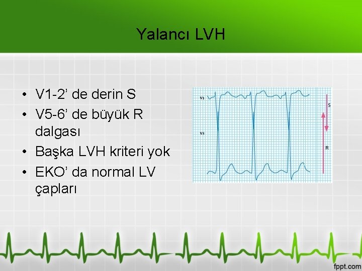 Yalancı LVH • V 1 -2’ de derin S • V 5 -6’ de
