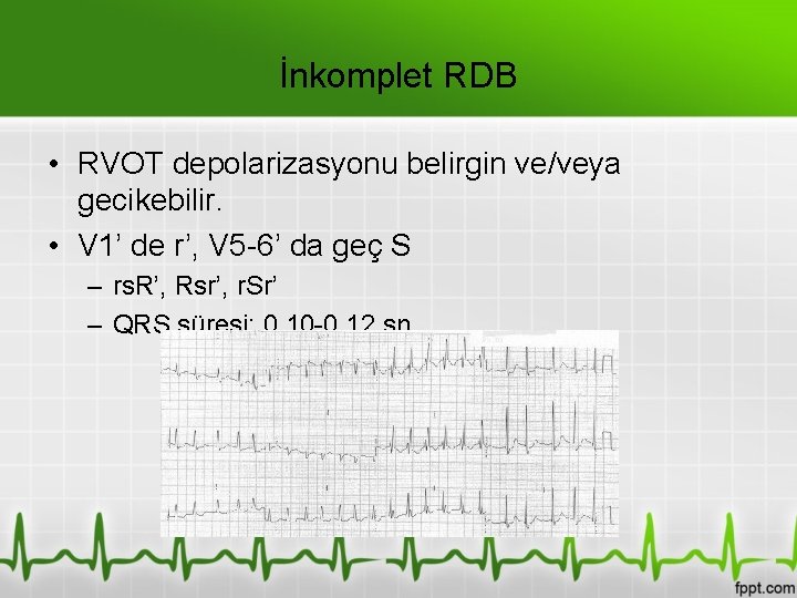 İnkomplet RDB • RVOT depolarizasyonu belirgin ve/veya gecikebilir. • V 1’ de r’, V