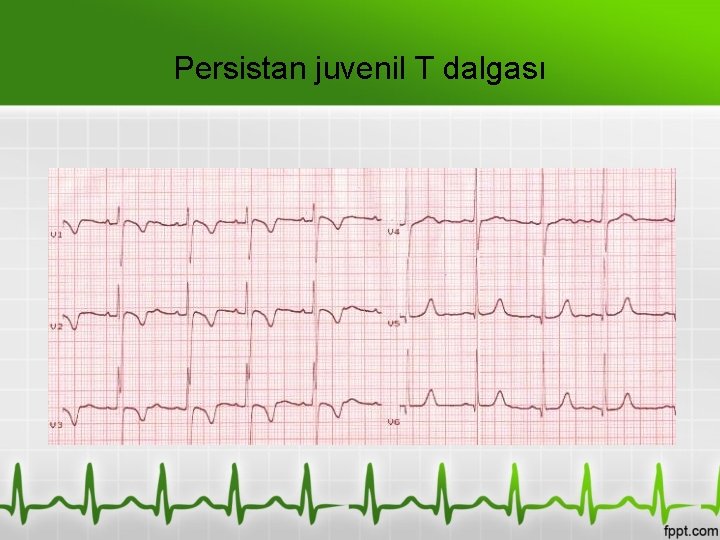 Persistan juvenil T dalgası 