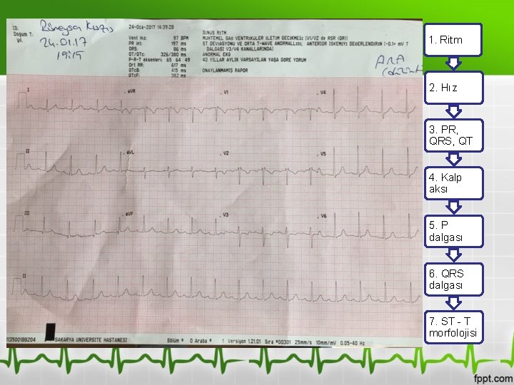 1. Ritm 2. Hız 3. PR, QRS, QT 4. Kalp aksı 5. P dalgası