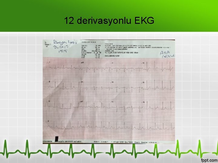 12 derivasyonlu EKG 