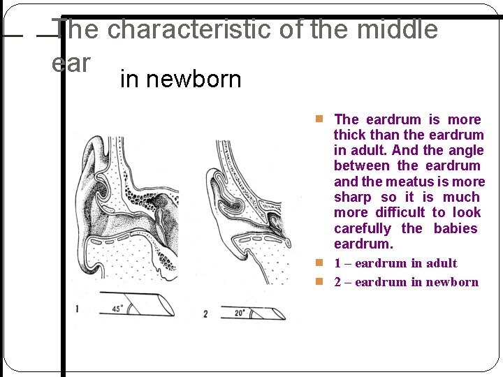 The characteristic of the middle ear in newborn The eardrum is more thick than The characteristic of the middle ear in newborn The eardrum is more thick than