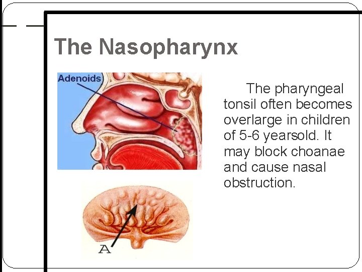 The Nasopharynx The pharyngeal tonsil often becomes overlarge in children of 5 6 yearsold. The Nasopharynx The pharyngeal tonsil often becomes overlarge in children of 5 6 yearsold.
