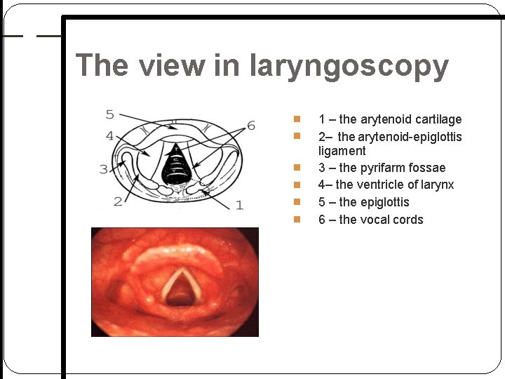 The view in laryngoscopy 1 – the arytenoid cartilage 2– the arytenoid epiglottis ligament The view in laryngoscopy 1 – the arytenoid cartilage 2– the arytenoid epiglottis ligament
