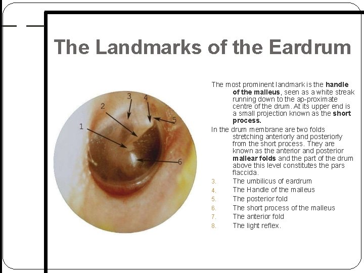 The Landmarks of the Eardrum The most prominent landmark is the handle of the The Landmarks of the Eardrum The most prominent landmark is the handle of the
