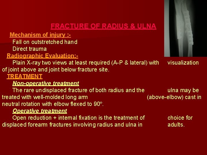 FRACTURE OF RADIUS & ULNA Mechanism of injury : Fall on outstretched hand Direct