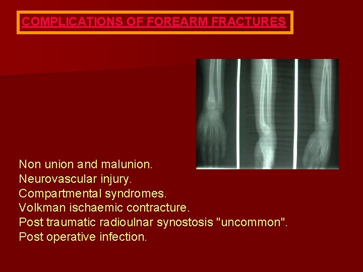 COMPLICATIONS OF FOREARM FRACTURES Non union and malunion. Neurovascular injury. Compartmental syndromes. Volkman ischaemic