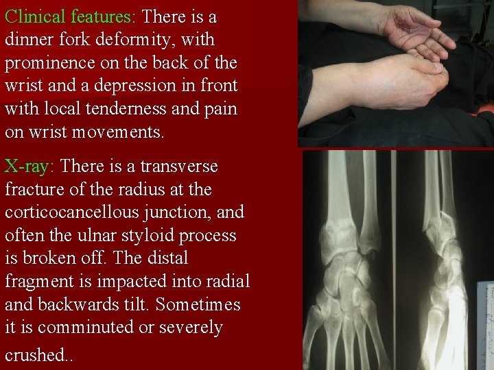 Clinical features: There is a dinner fork deformity, with prominence on the back of