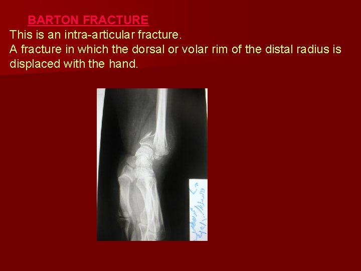 BARTON FRACTURE This is an intra-articular fracture. A fracture in which the dorsal or