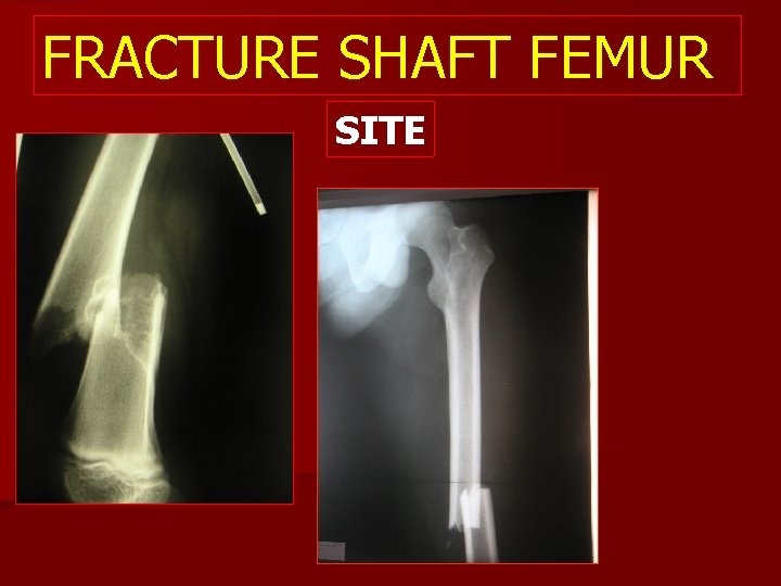 FRACTURE SHAFT FEMUR SITE 