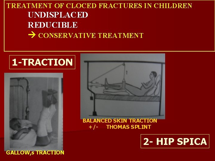 TREATMENT OF CLOCED FRACTURES IN CHILDREN UNDISPLACED REDUCIBLE CONSERVATIVE TREATMENT 1 -TRACTION BALANCED SKIN