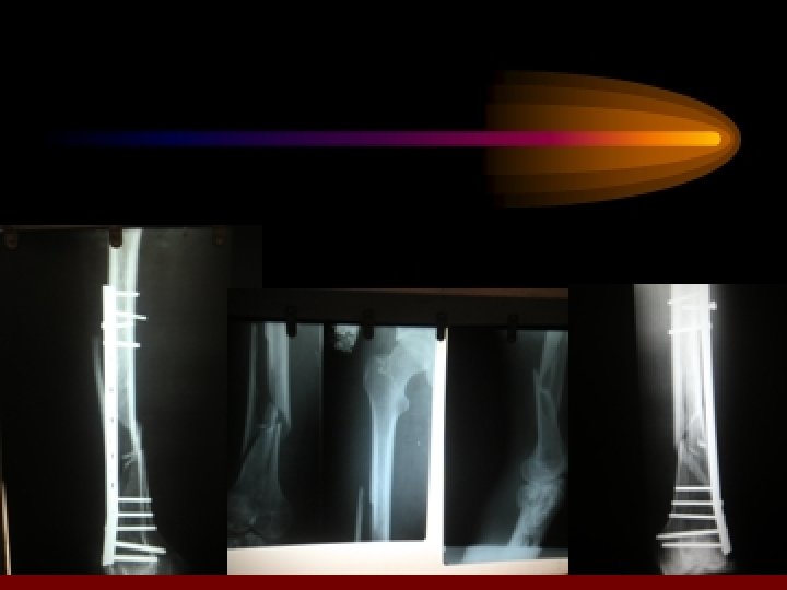 TREATMENT OF CLOCED FRACTURES UNDISPLACED REDUCIBLE CONSERVATIVE TREATMENT 1 -TRACTION GALLOW, s TRACTION SKIN