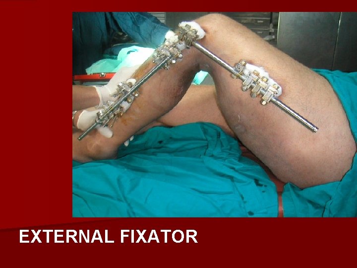 EXTERNAL FIXATOR 