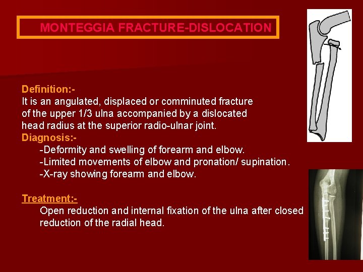 MONTEGGIA FRACTURE-DISLOCATION Definition: It is an angulated, displaced or comminuted fracture of the upper