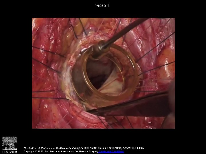 Video 1 The Journal of Thoracic and Cardiovascular Surgery 2018 15689 -95. e 2