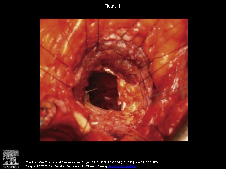Figure 1 The Journal of Thoracic and Cardiovascular Surgery 2018 15689 -95. e 2