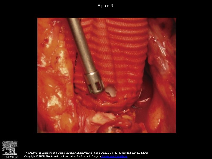 Figure 3 The Journal of Thoracic and Cardiovascular Surgery 2018 15689 -95. e 2