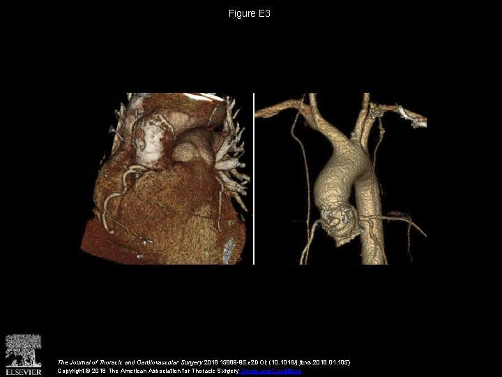 Figure E 3 The Journal of Thoracic and Cardiovascular Surgery 2018 15689 -95. e