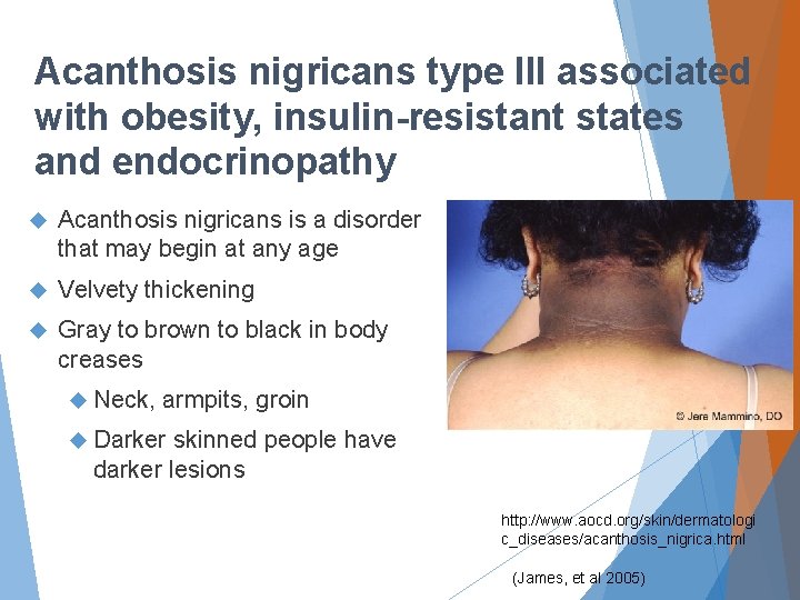 Acanthosis nigricans type III associated with obesity, insulin-resistant states and endocrinopathy Acanthosis nigricans is