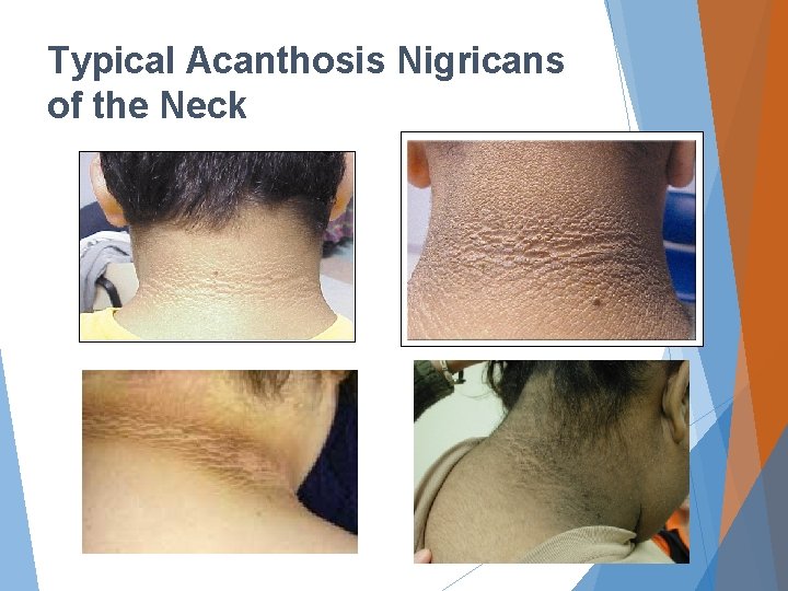 Typical Acanthosis Nigricans of the Neck 