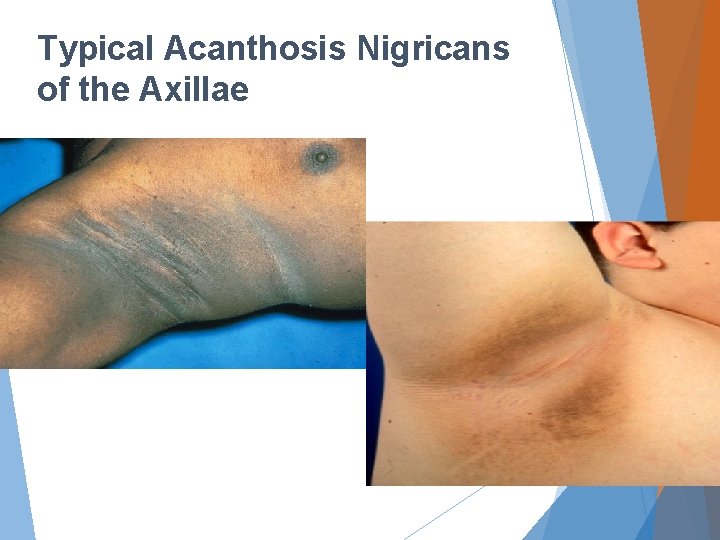 Typical Acanthosis Nigricans of the Axillae 