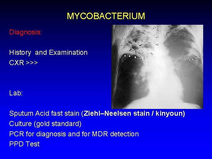MYCOBACTERIUM Diagnosis: History and Examination CXR >>> Lab: Sputum Acid fast stain (Ziehl–Neelsen stain